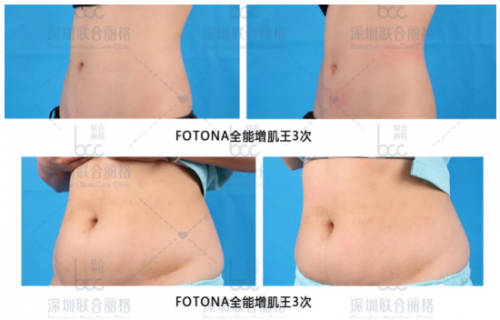 瘦腰、翘臀、瘦大腿,fotona4D兄弟:fotona星丽人增肌减脂王疗效翻倍