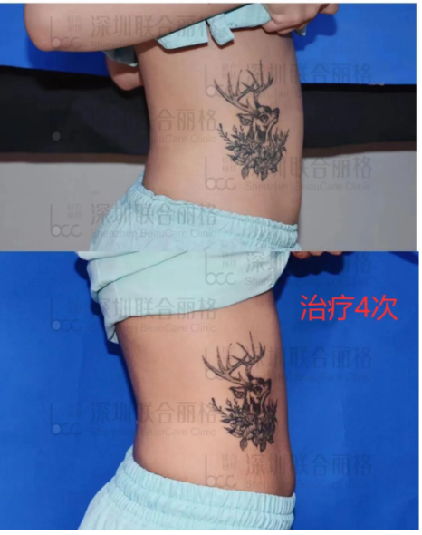 瘦腰、翘臀、瘦大腿,fotona4D兄弟:fotona星丽人增肌减脂王疗效翻倍