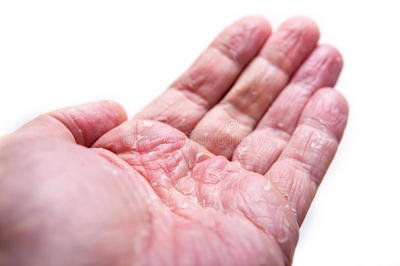 日光性湿疹的预防方法以及治疗方法