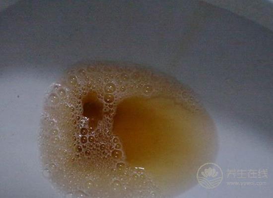 尿液发黄像浓茶？小心是肝胆出了问题！